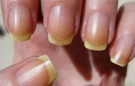 Nail fogfehérítés otthon