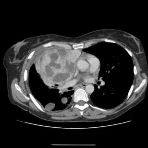 Sarcoma - milyen tüneteket, a betegség kép, okai, típusai, kezelése és prognózisa