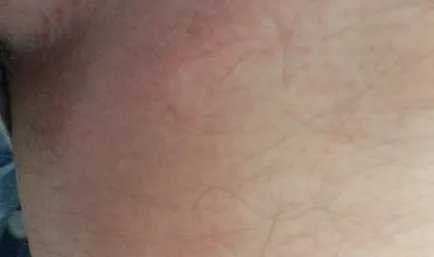 Hámló bőr lábai között fotó, esetleges betegség, kezelés, növedékek a bőrön (fotó) Hámló bőr lábai között fotó, esetleges betegség, kezelés, növedékek a bőrön