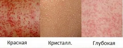 Kiütés és viszketés a test egy felnőtt kezelésére egy fotó az ok és betegség (a test) Kiütés és viszketés a test egy felnőtt a kezelés a betegség okainak és fotók