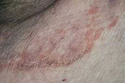 Kiütés és viszketés a test egy felnőtt a kezelés a betegség okoz, és képek (képek) Kiütés és viszketés a test egy felnőtt a kezelés a betegség okainak és fotók