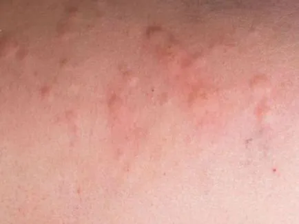 Kiütés és viszketés a test egy felnőtt kezelési és betegség Picture okok (okok) Kiütés és viszketés a test egy felnőtt a kezelés a betegség okainak és fotók