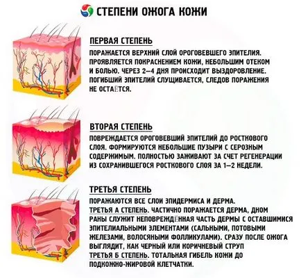 Mi gyógyít égések 1, 2, 3 és 4 fok (égési) Mit gyógyít égések 1., 2., 3. és 4. fok