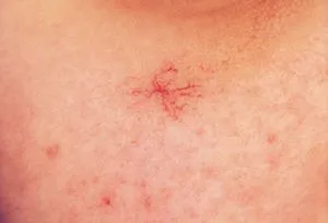 Spider erek a test (arc, mellkas, lábak) okok és a kezelés