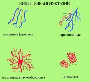 Spider erek a test (arc, mellkas, lábak) okok és a kezelés