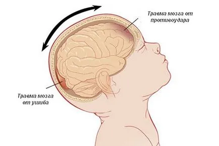 agyrázkódás a gyermek tünetei, diagnózisa, kezelése, következményei