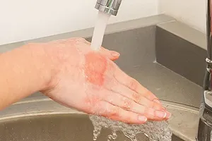 Burn kezelés medvetalp