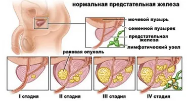 A prosztatagyulladás és kezelésére használt gyógyszerek
