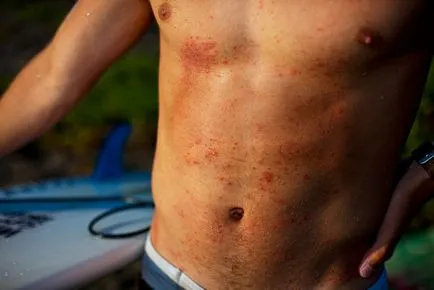 Az ok viszketés