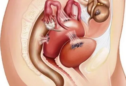 Herbs méh endometriózis, amely kezelt (méh) Herbs méh endometriózis, amelynek tisztítása