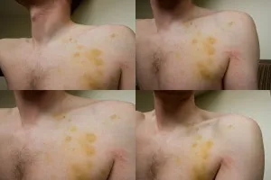Szívbetegségek zúzódás tünetek, következmények kezelésére, diagnózis, prognózis