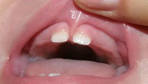 Frenulum A felső ajak