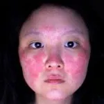 Lupus fotó, tünetei és kezelése a betegség