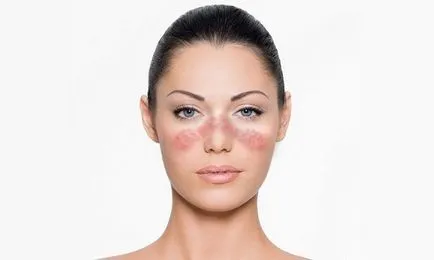 Lupus fotó, tünetei és kezelése a betegség