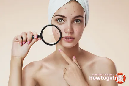 5 Ways-hoz megszabadulni a pattanások egy órán belül! ♥ Dana Tinker