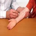 Allergiás betegségek és különféle okokból (allergia) Allergiás betegségek, típusok és okai