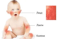 Allergia a baba bőrét tünetei és kezelése népi jogorvoslat és a gyógyszeres kezelés (videó) (az immunrendszert) Allergia a baba bőrét tünetei és kezelése népi jogorvoslat és a gyógyszeres kezelés (videó)