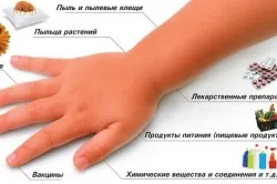 Allergia a baba bőrét tünetei és kezelése népi jogorvoslat és a gyógyszeres kezelés (videó) (bőr) Allergia a baba bőrét tünetei és kezelése népi jogorvoslat és a gyógyszeres kezelés (videó)