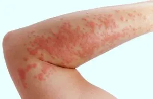 Allergiás betegségek, fajták és a kezelés