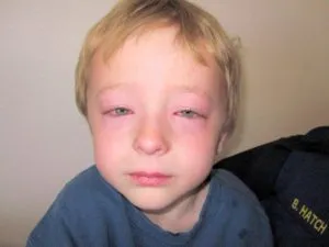 Allergiás betegségek, fajták és a kezelés