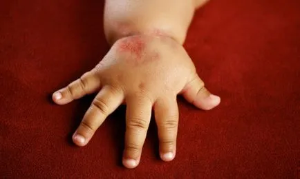 Allergia a baba bőrét tünetei és kezelése népi jogorvoslat és a gyógyszeres kezelés (videó) (bőr) Allergia a baba bőrét tünetei és kezelése népi jogorvoslat és a gyógyszeres kezelés (videó)