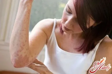 Allergiás reakciók kezelésére és megelőzésére
