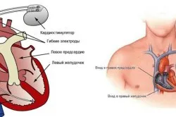 Blokádja bal szárblokk köteg tünetek és kezelés (elsősorban a szív) A blokád a bal lábát a His-kötegen tünetek és a kezelés
