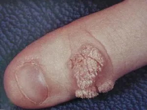 Wart ujján