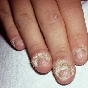 Wart ujján