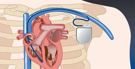 Bradycardia, kardiális tünetek, a kezelés és az első támogatás rohamok (tünetek) Bradycardia, kardiális tünetek, a kezelés és az első támogatás támadás