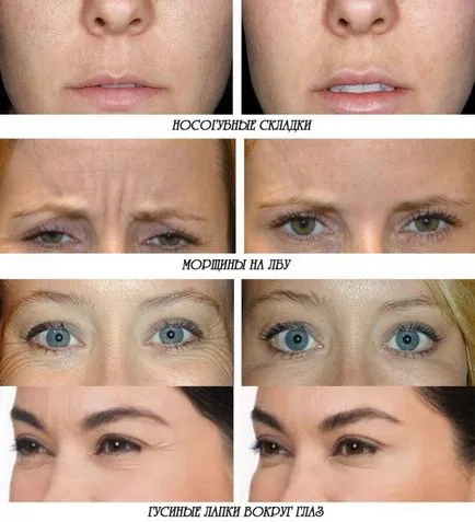 Botox az arc - áttekinti az eljárást, és a lehetséges következmények