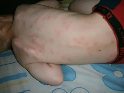 A veszélyes allergia gyermekeknél