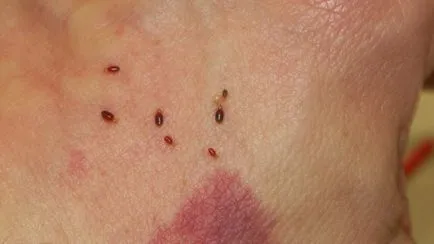 Az ágyi poloskák veszélyesek az emberi következményei harap, és nyomokban