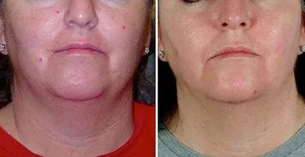 Cipő ultrahang arc (hámlás arc ultrahang) - mi ez, egy visszacsatoló ellenjavallatok (a tejsav) Tisztító ultrahangos személy (ultrahangos arc peeling) - mi ez, áttekintésre, ellenjavallatok,
