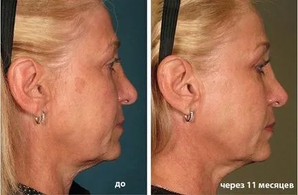 Tisztító ultrahangos személy (ultrahangos arc peeling) - mi ez, áttekintésre, ellenjavallatok (ultrahang) Tisztító ultrahangos személy (ultrahangos arc peeling) - mi ez, áttekintésre, ellenjavallatok,