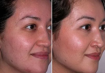 Tisztító ultrahangos személy (ultrahangos arc peeling) - mi ez, áttekintésre, ellenjavallatok (ultrahang) Tisztító ultrahangos személy (ultrahangos arc peeling) - mi ez, áttekintésre, ellenjavallatok,