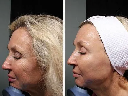 Tisztító ultrahangos személy (ultrahangos arc peeling) - mi ez, áttekintésre, ellenjavallatok (takarítás) Tisztító ultrahangos személy (ultrahangos arc peeling) - mi ez, áttekintésre, ellenjavallatok,