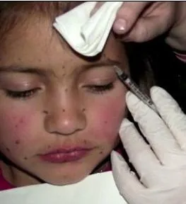 Mi az a „Botox” megéri alkalmazni