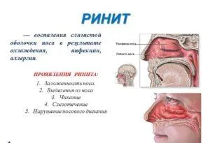 Mi orrfolyás (rinitisz), hogyan és miért van kialakítva