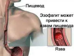 Disztális oesophagitis tünetek és a kezelés