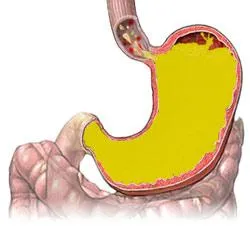 Disztális oesophagitis tünetek és a kezelés