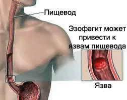 Disztális oesophagitis tünetek és a kezelés