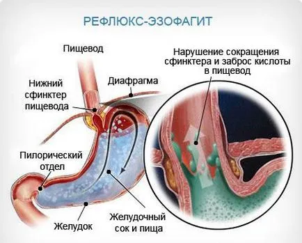 Disztális oesophagitis tünetek és a kezelés