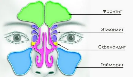 Ethmoiditis típusok okoz, jelek, tünetek, kezelés