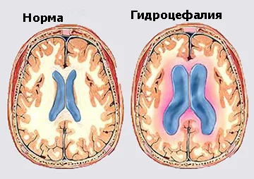 Vízfejével szindróma csecsemők - tünetek és kezelés