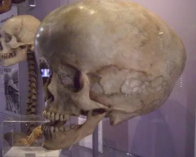 Vízfejével hipertenzív szindróma jelei és smptomy betegség kezelési
