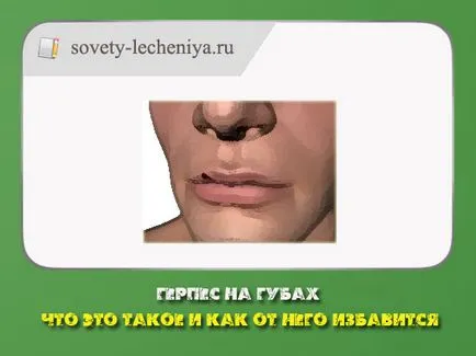Herpesz az ajkakon, mi ez, és hogyan lehet megszabadulni (ajak) is Herpesz az ajkakon, mi ez, és hogyan lehet megszabadulni tőle