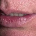 Glossalgia - kezelés, fotó, tünetei, hogyan kell kezelni glossalgia
