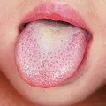 Glossalgia - kezelés, fotó, tünetei, hogyan kell kezelni glossalgia