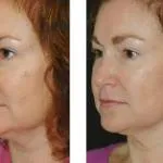 Glycolic hámlás (sav), hogyan kell csinálni otthon, ellenjavallatok (fotók előtt és után)